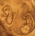 1985 | 05 | ТРАВЕНЬ 1985 року. У США жінка, що проходила лікування від безпліддя, народжує сім близнюків.